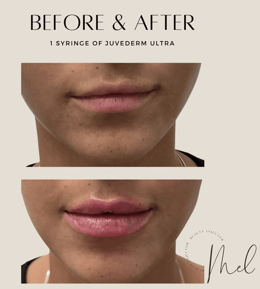 Lips by Melissa Perez, RN