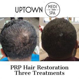 PRP HAIR/SKIN RESTORATION - Uptown Medispa