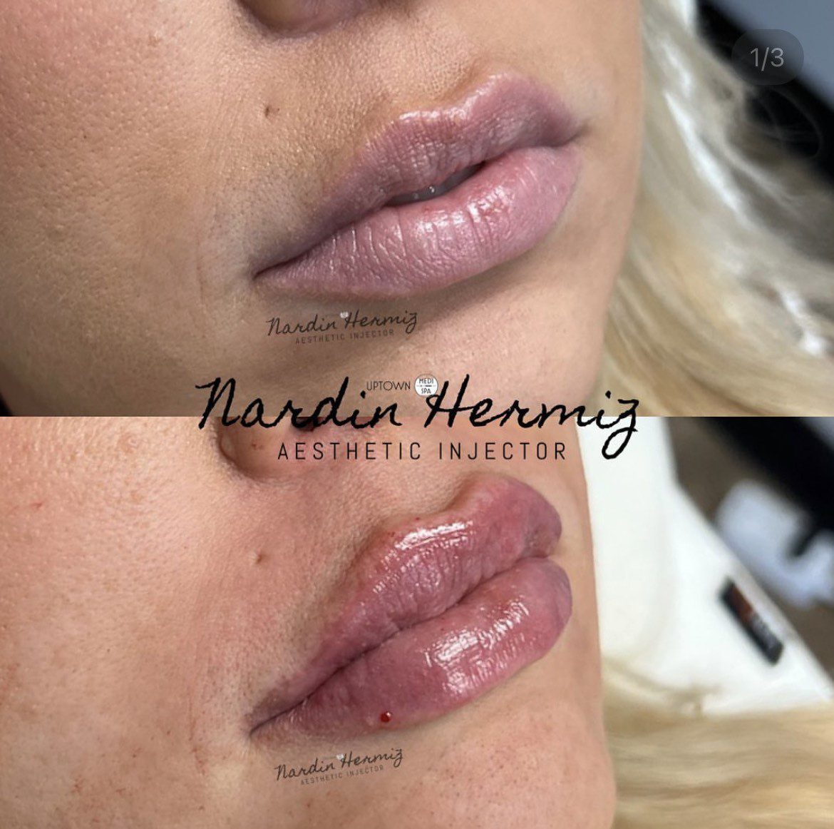 Lip Fillers Gone Wrong Or A Dream Gone Sour? — Get The Insight